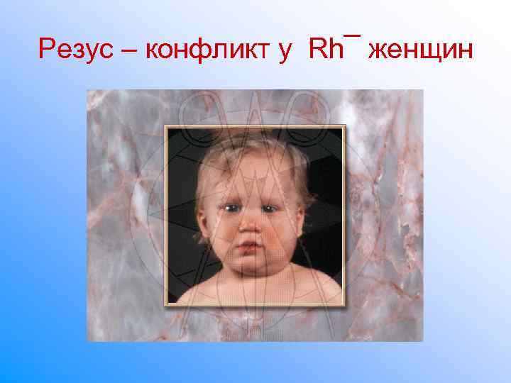 Резус – конфликт у Rh¯ женщин Резус – конфликт у Rh¯ женщин