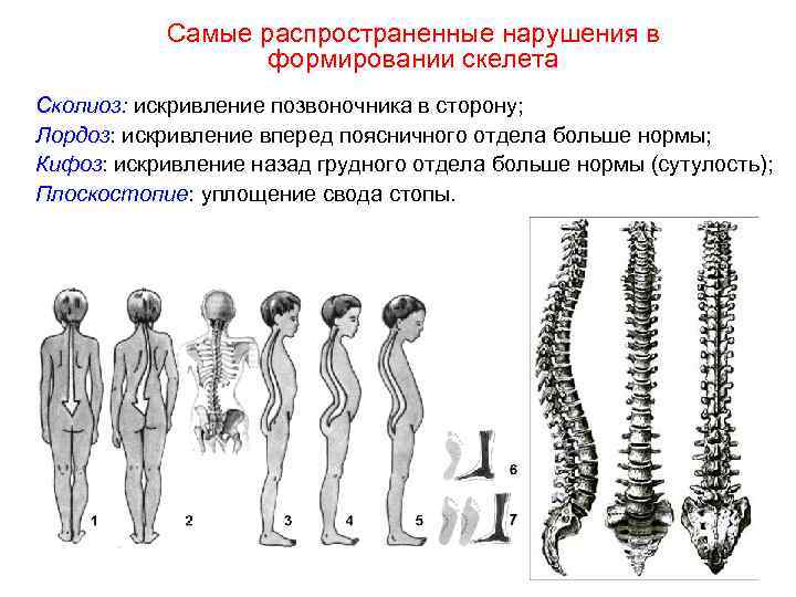   Самые распространенные нарушения в    формировании скелета Сколиоз: искривление позвоночника