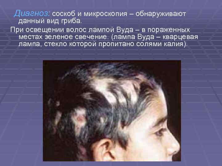 Диагноз: соскоб и микроскопия – обнаруживают данный вид гриба. При освещении волос лампой Вуда
