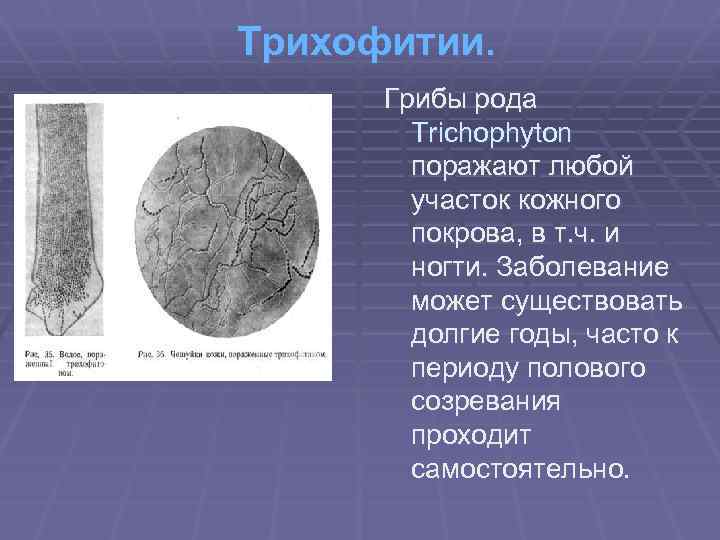 Трихофитии. Грибы рода Trichophyton поражают любой участок кожного покрова, в т. ч. и ногти.