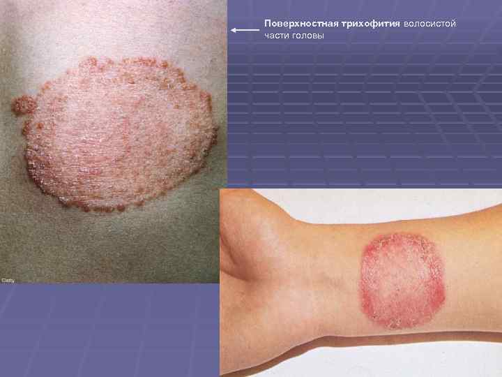 Поверхностная трихофития волосистой части головы 