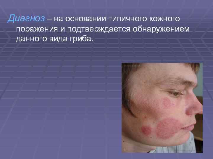 Диагноз – на основании типичного кожного поражения и подтверждается обнаружением данного вида гриба. 