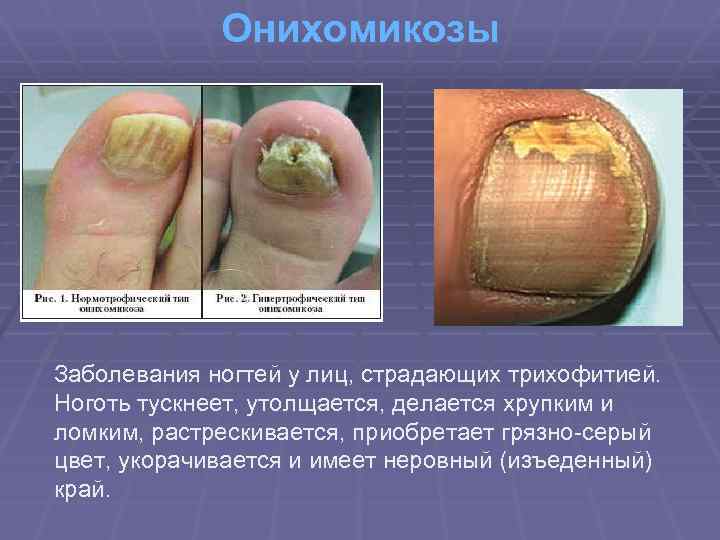 Онихомикозы Заболевания ногтей у лиц, страдающих трихофитией. Ноготь тускнеет, утолщается, делается хрупким и ломким,