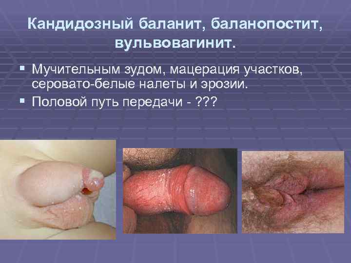 Кандидозный баланит, баланопостит, вульвовагинит. § Мучительным зудом, мацерация участков, серовато-белые налеты и эрозии. §