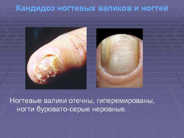 Кандидоз ногтевых валиков и ногтей Ногтевые валики отечны, гиперемированы, ногти буровато-серые неровные. 