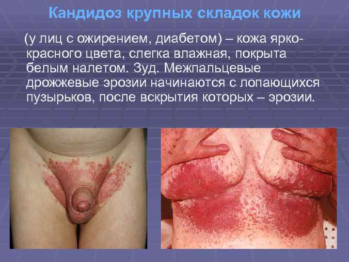 Кандидоз крупных складок кожи (у лиц с ожирением, диабетом) – кожа яркокрасного цвета, слегка