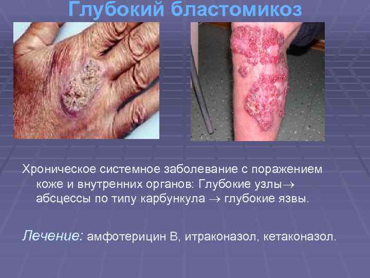 Глубокий бластомикоз Хроническое системное заболевание с поражением коже и внутренних органов: Глубокие узлы абсцессы