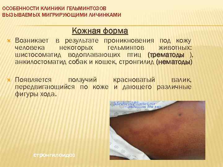 ОСОБЕННОСТИ КЛИНИКИ ГЕЛЬМИНТОЗОВ ВЫЗЫВАЕМЫХ МИГРИРУЮЩИМИ ЛИЧИНКАМИ    Кожная форма Возникает в результате