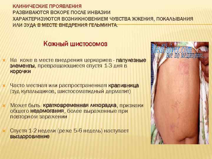  КЛИНИЧЕСКИЕ ПРОЯВЛЕНИЯ РАЗВИВАЮТСЯ ВСКОРЕ ПОСЛЕ ИНВАЗИИ ХАРАКТЕРИЗУЮТСЯ ВОЗНИКНОВЕНИЕМ ЧУВСТВА ЖЖЕНИЯ, ПОКАЛЫВАНИЯ ИЛИ ЗУДА