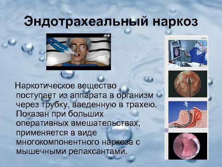  Эндотрахеальный наркоз  Наркотическое вещество поступает из аппарата в организм через трубку, введенную