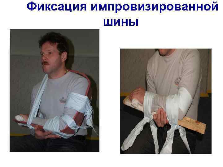 Фиксация импровизированной шины 