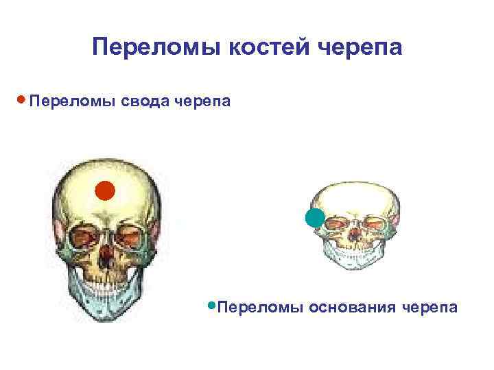 Перелом кости свода черепа