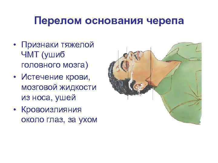  Перелом основания черепа  • Признаки тяжелой  ЧМТ (ушиб  головного мозга)