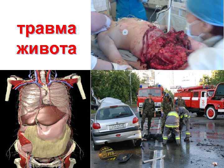 травма живота 