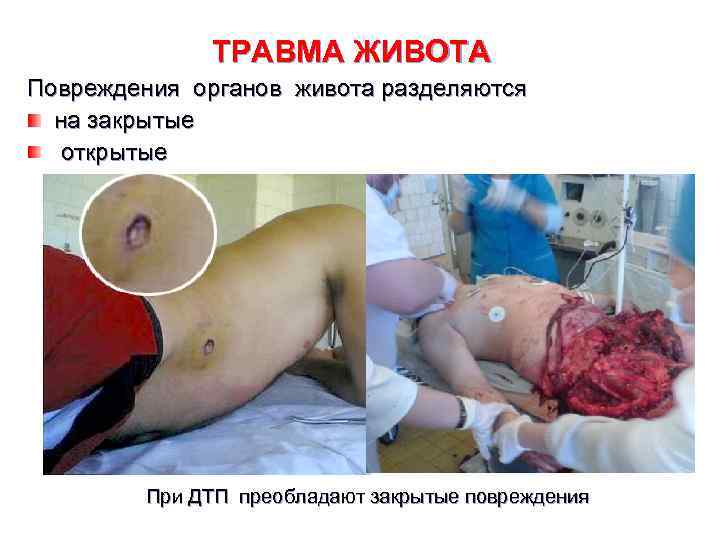    ТРАВМА ЖИВОТА Повреждения органов живота разделяются  на закрытые  открытые