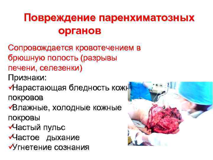   Повреждение паренхиматозных   органов Сопровождается кровотечением в брюшную полость (разрывы печени,