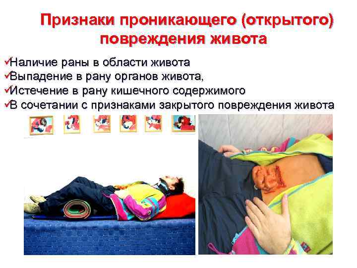  Признаки проникающего (открытого)  повреждения живота üНаличие раны в области живота üВыпадение в