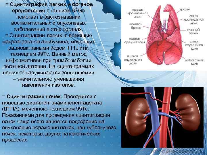  = Сцинтиграфия легких и органов средостения с галлием 67 Ga  помогает в