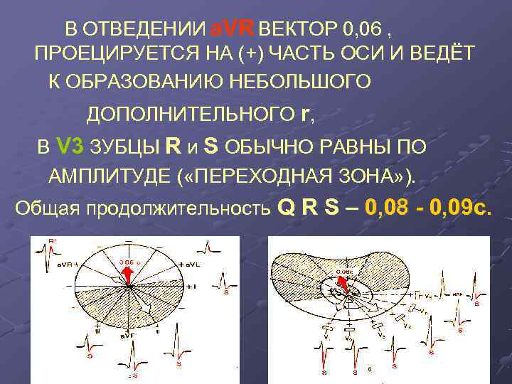   В ОТВЕДЕНИИ а. VR ВЕКТОР 0, 06 ,  ПРОЕЦИРУЕТСЯ НА (+)