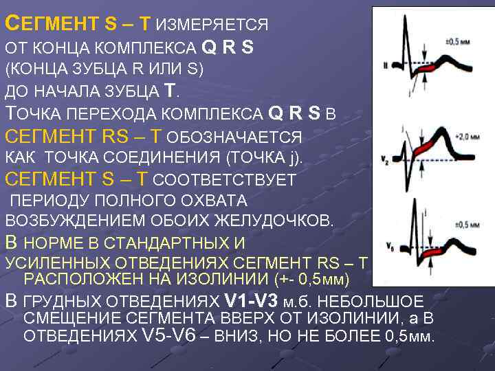 СЕГМЕНТ S – T ИЗМЕРЯЕТСЯ ОТ КОНЦА КОМПЛЕКСА Q R S (КОНЦА ЗУБЦА R