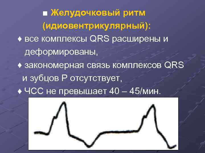 Желудочковый ритм. Ускоренный желудочковый ритм на ЭКГ. ЭКГ при идиовентрикулярном ритме. ЭКГ при желудочковом ритме. ЭКГ признаки идиовентрикулярного ритма.