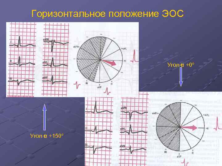 Горизонтальная эос. Горизонтальная ось сердца на ЭКГ. Отклонение ЭОС горизонтальное. Горизонтальная ЭОС сердца на ЭКГ. Горизонтальное положение ЭОС на ЭКГ.