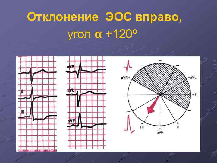 Экг резкое отклонение влево