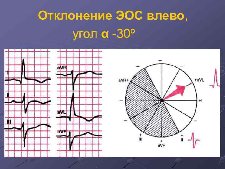 Отклонение эос влево. Отклонение ЭОС на ЭКГ. Отклонение ЭОС влево на ЭКГ. Электрическая ось зубца р.