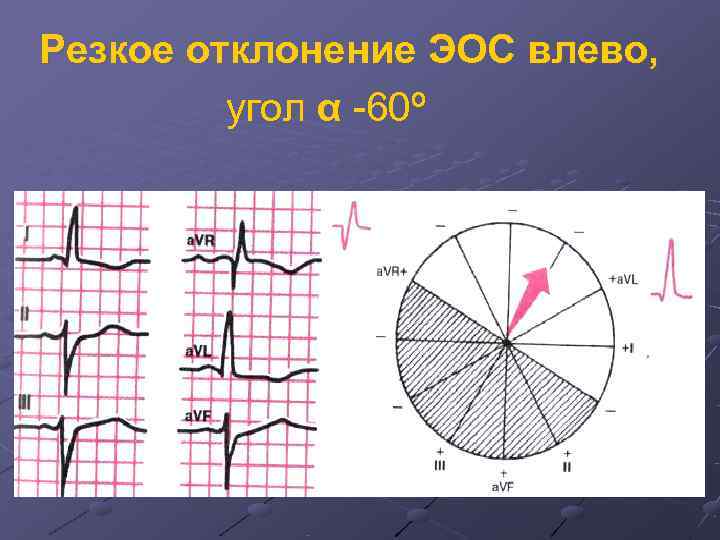 Отклонения на экг