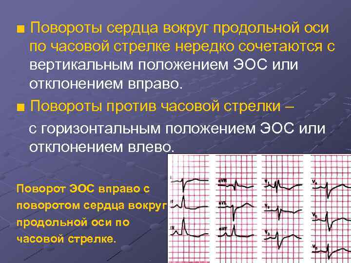 Ось повернута. Поворот правым желудочком кпереди на ЭКГ. Повороты сердца вокруг оси на ЭКГ. Поворот сердца вокруг продольной оси против часовой стрелки на ЭКГ. Повороты сердца вокруг продольной оси на ЭКГ.