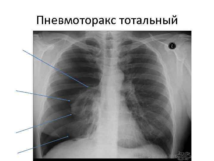 Пневмоторакс тотальный 