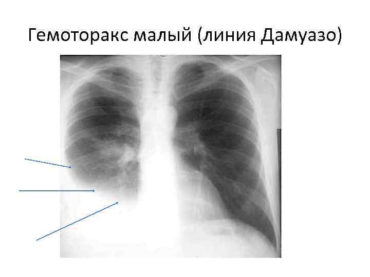 Гемоторакс малый (линия Дамуазо) 