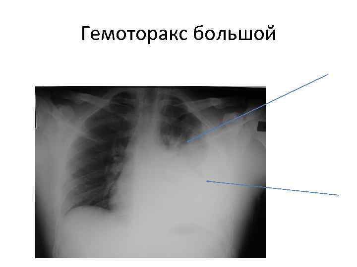 Гемоторакс большой 