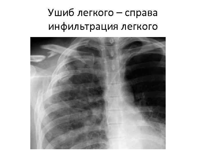 Ушиб легкого – справа инфильтрация легкого 