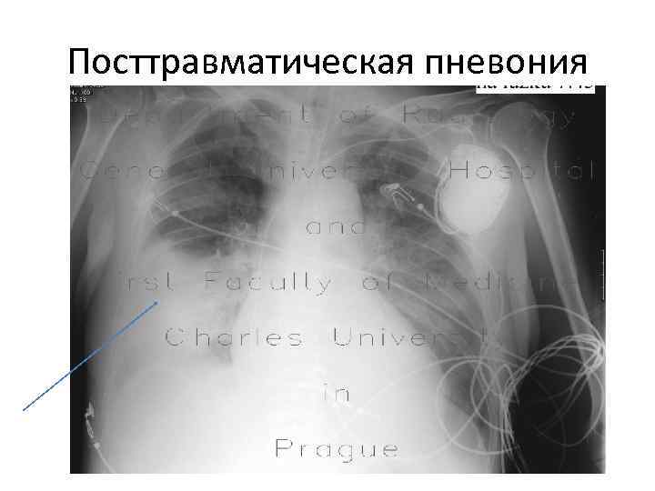 Посттравматическая пневония 
