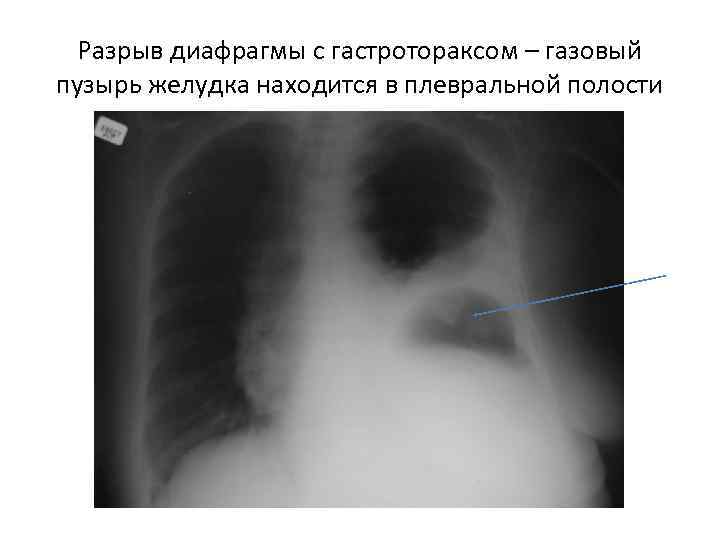  Разрыв диафрагмы с гастротораксом – газовый пузырь желудка находится в плевральной полости 