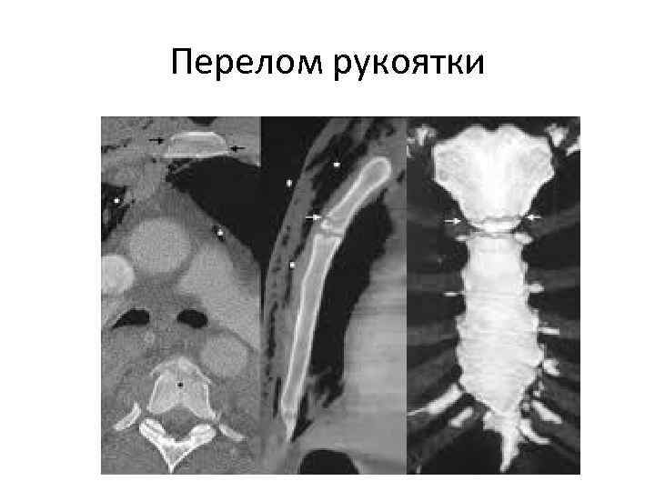 Перелом рукоятки 