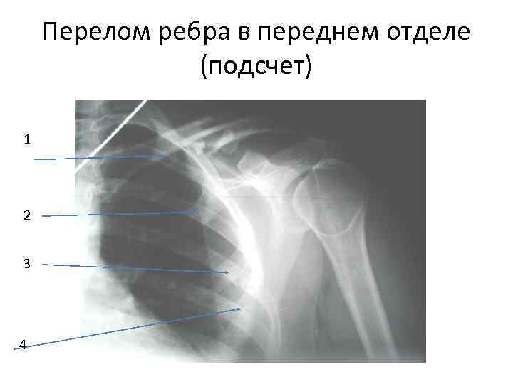   Перелом ребра в переднем отделе    (подсчет) 1 2 