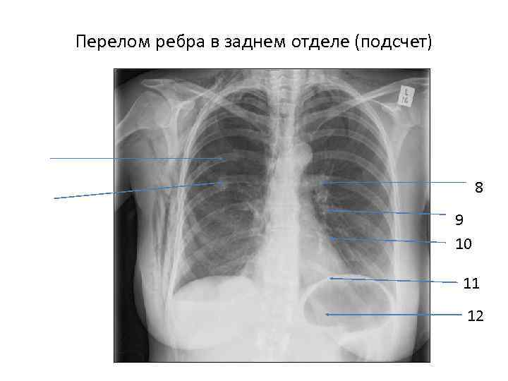 Перелом ребра в заднем отделе (подсчет)     8   