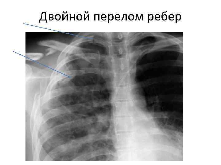 Двойной перелом ребер 