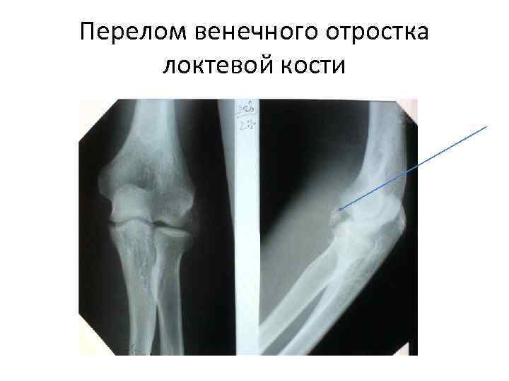 Перелом венечного отростка  локтевой кости 