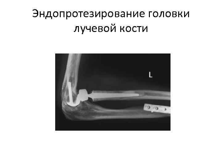 Эндопротезирование головки  лучевой кости 
