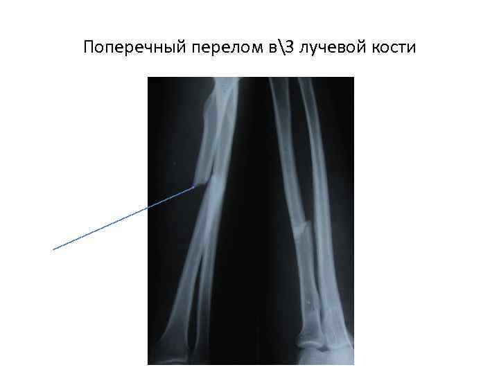 Поперечный перелом в3 лучевой кости 