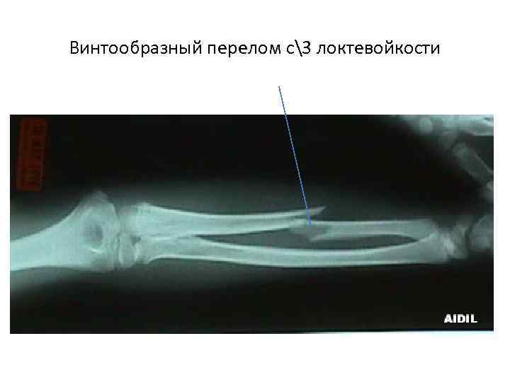 Винтообразный перелом с3 локтевойкости 