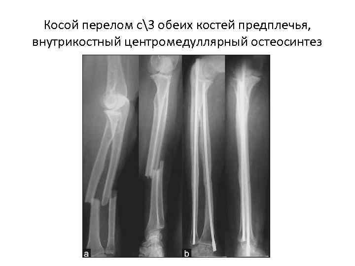  Косой перелом с3 обеих костей предплечья, внутрикостный центромедуллярный остеосинтез 
