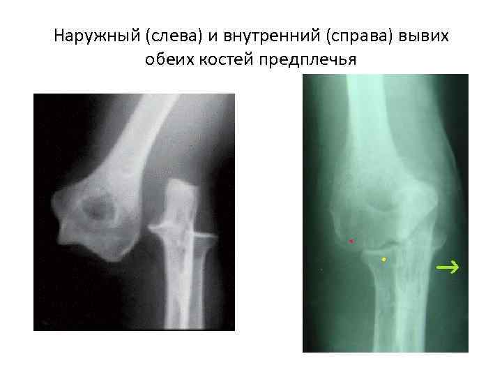 Наружный (слева) и внутренний (справа) вывих   обеих костей предплечья 