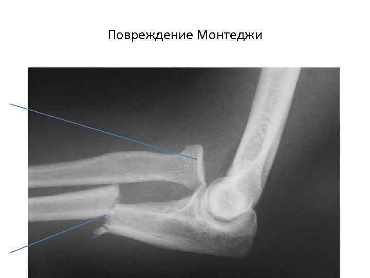 Повреждение Монтеджи 