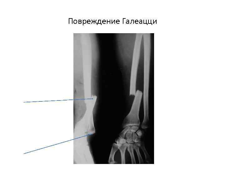 Повреждение Галеацци 
