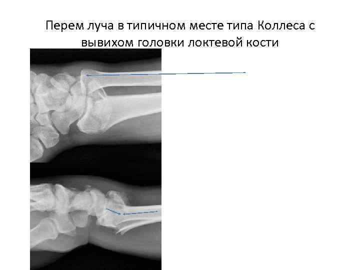 Перем луча в типичном месте типа Коллеса с вывихом головки локтевой кости 