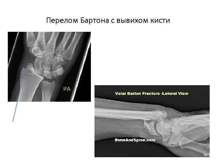 Перелом Бартона с вывихом кисти 